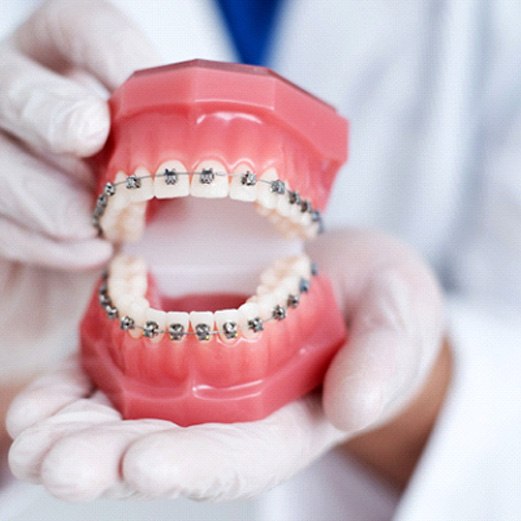 Dentist with white gloves holding model of teeth with traditional braces