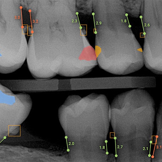 graphic of Overjet findings