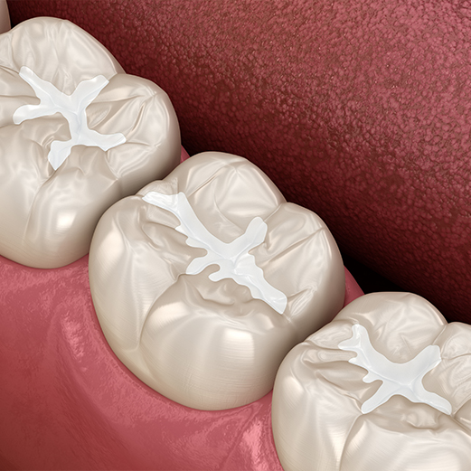 Animated row of teeth with dental sealants