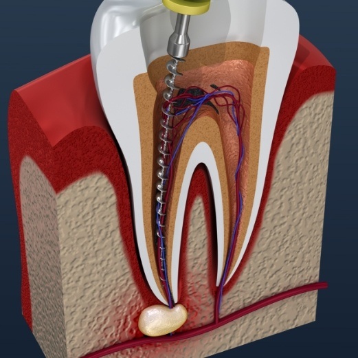 Animated dental tool performing pulp therapy