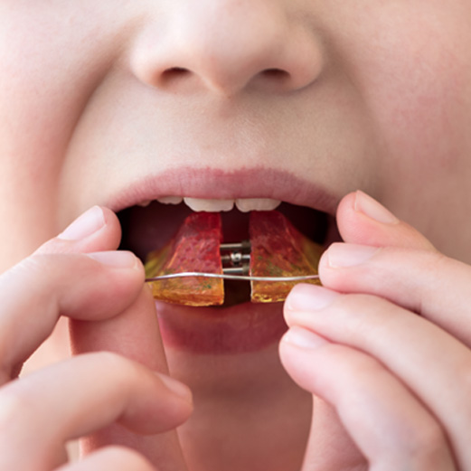 Young boy putting on adjustable retainer 