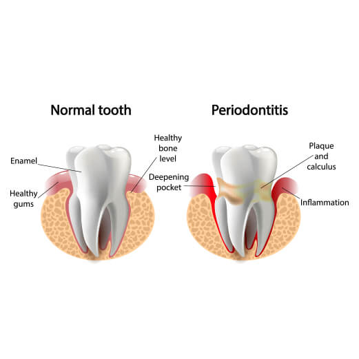 Model of normal tooth next to damaged tooth impacted by gum disease
