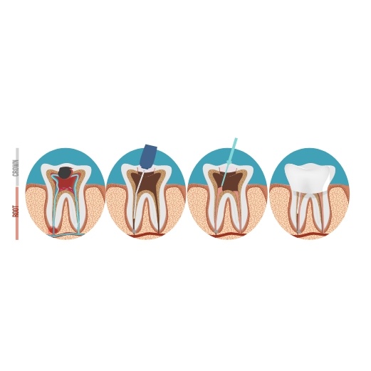 Animated steps of root canal treatment process