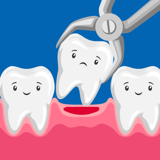 Animated tooth with sad face being extracted