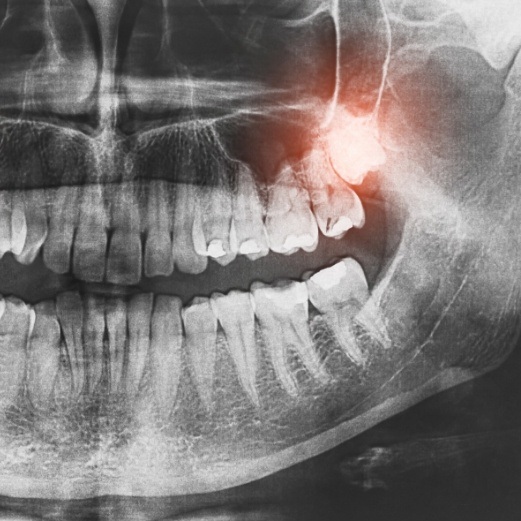 Dental x ray with impacted wisdom tooth highlighted red