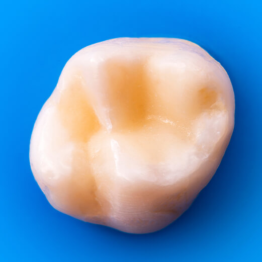 Close up of a tooth colored filling against blue background