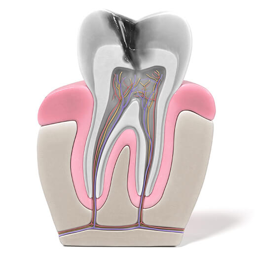 Model of damaged tooth needing root canal treatment in Schoharie