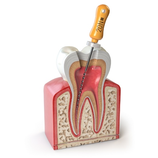 Animated dental tool performing root canal treatment inside of a tooth