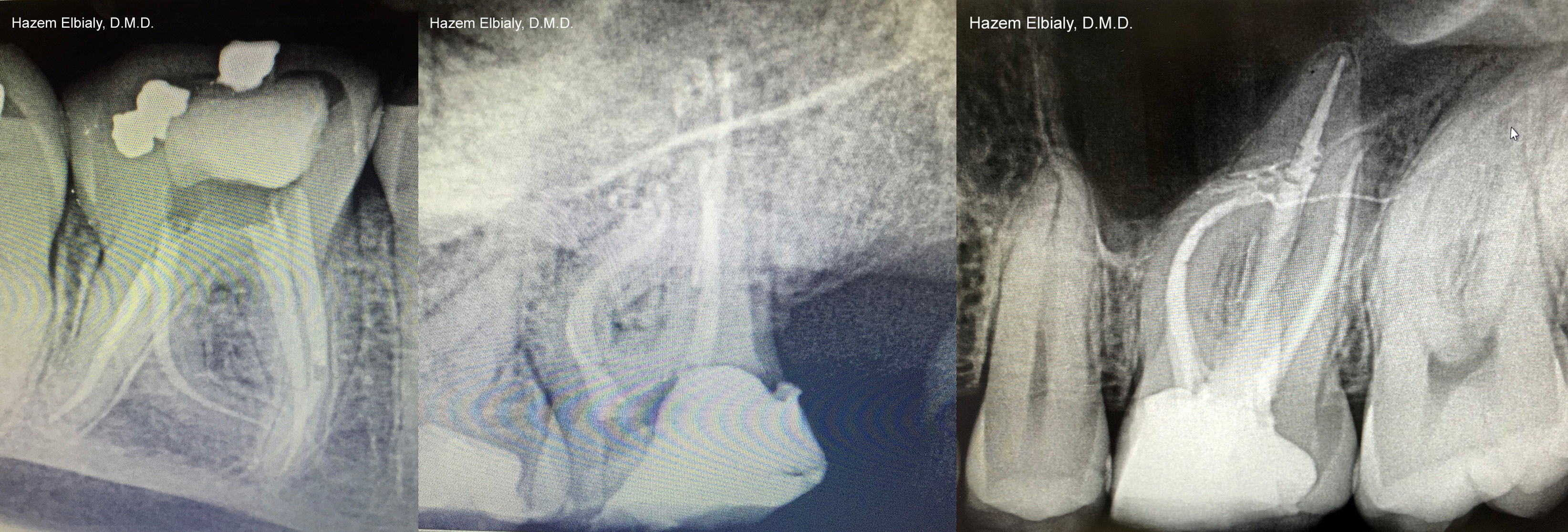 Collage of x rays taken of teeth after root canal treatment in Schoharie