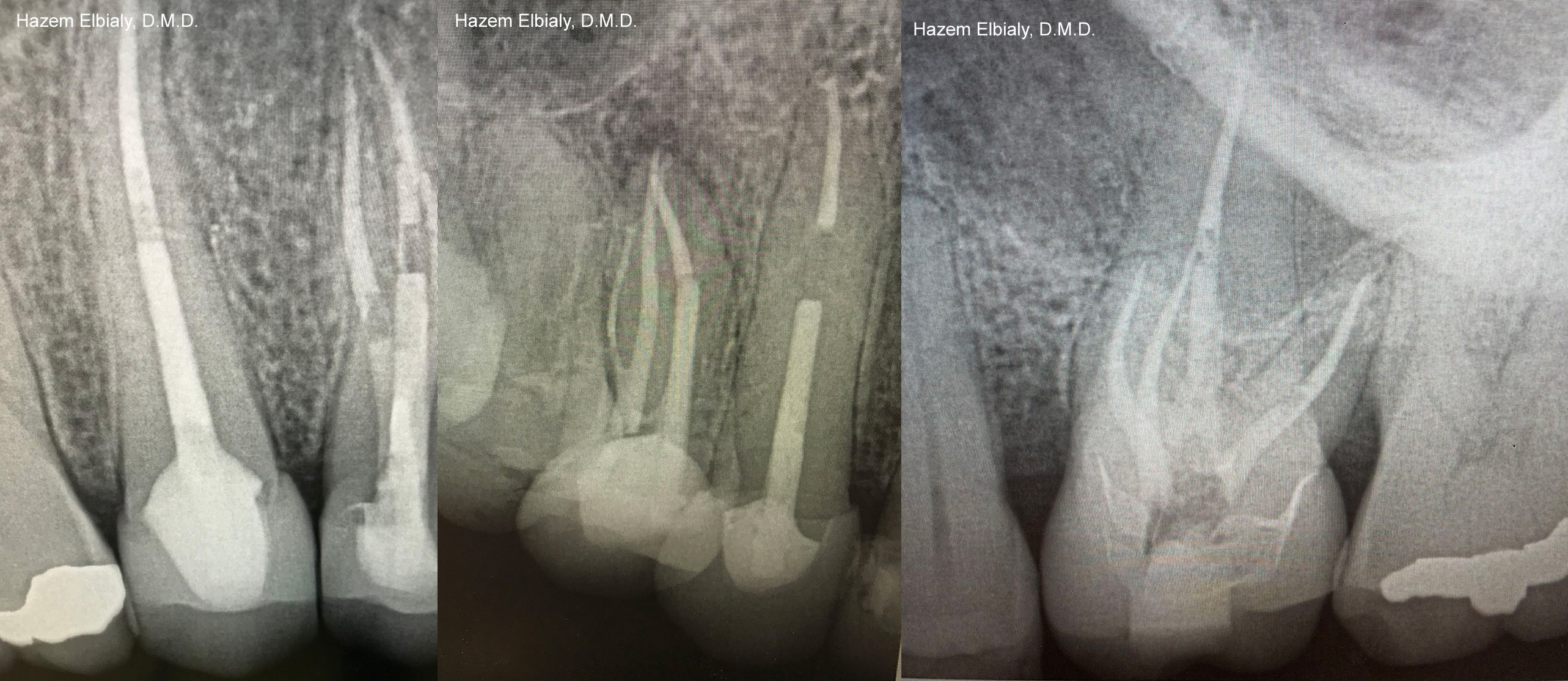 Collage of x rays taken of teeth after root canal treatment in Schoharie