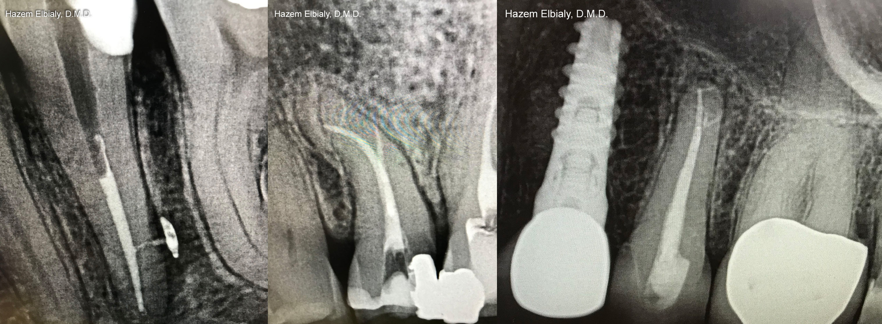 Collage of x rays taken of teeth after root canal treatment in Schoharie