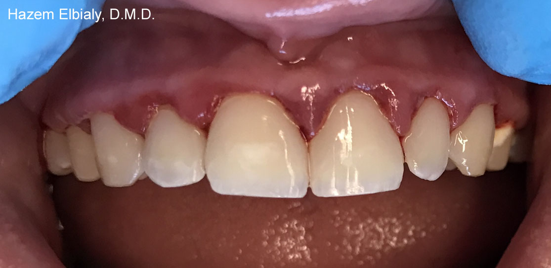 Close up of restored teeth after tooth colored fillings