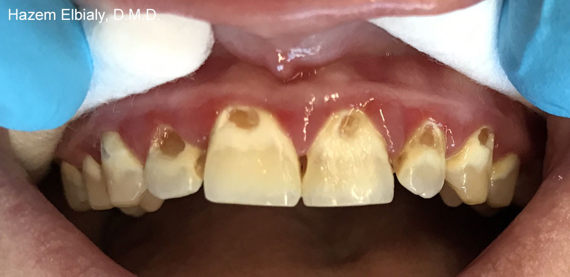 Close up of damaged teeth before tooth colored fillings