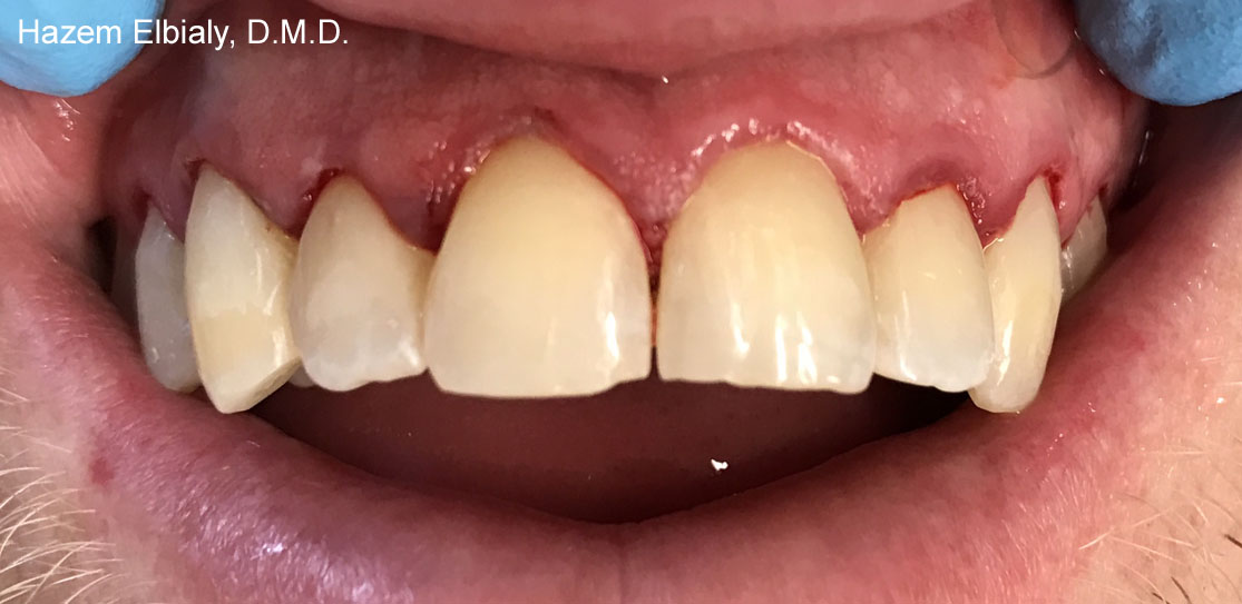 Close up of restored teeth after tooth colored fillings