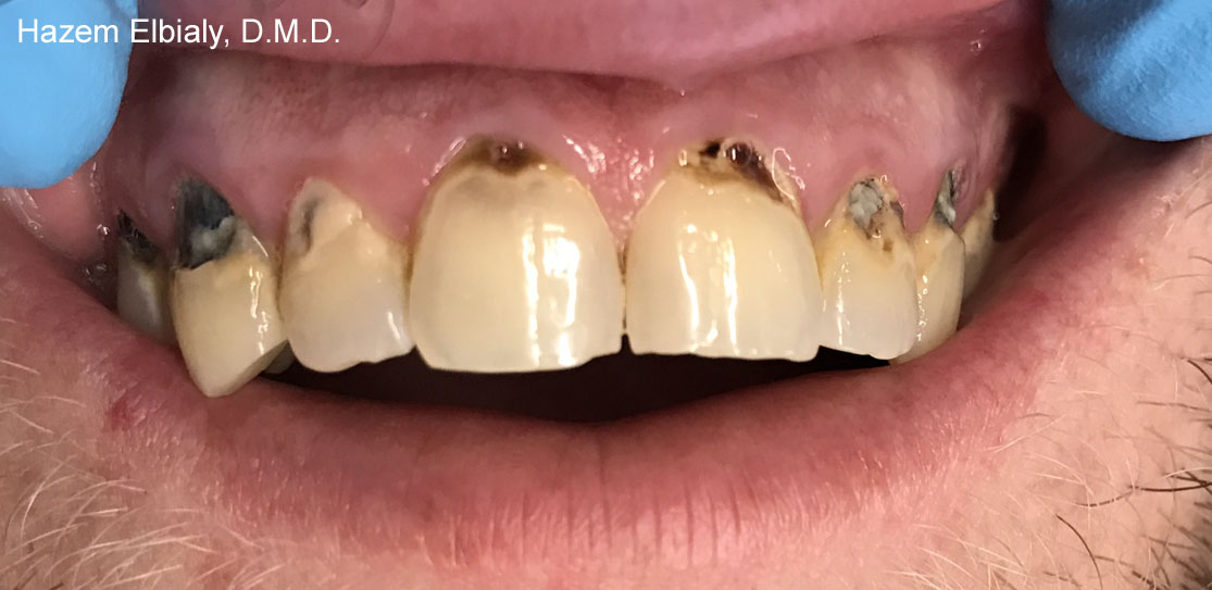 Close up of damaged teeth before tooth colored fillings