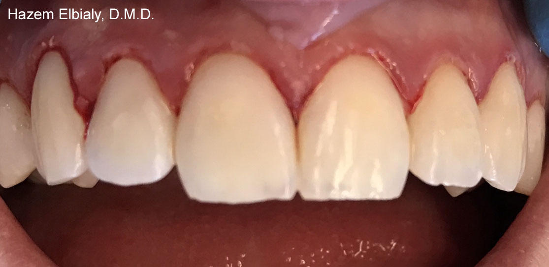 Close up of restored teeth after tooth colored fillings