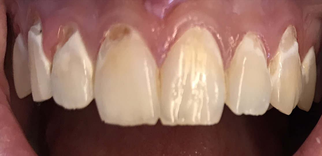 Close up of damaged teeth before tooth colored fillings