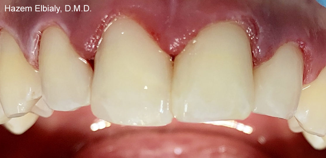 Close up of restored teeth after tooth colored fillings