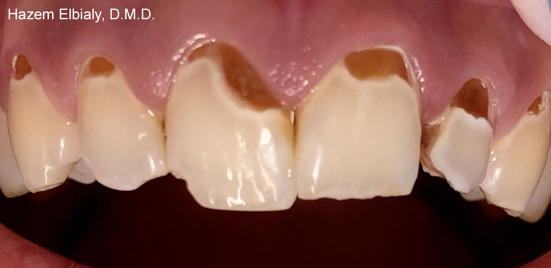 Close up of damaged teeth before tooth colored fillings