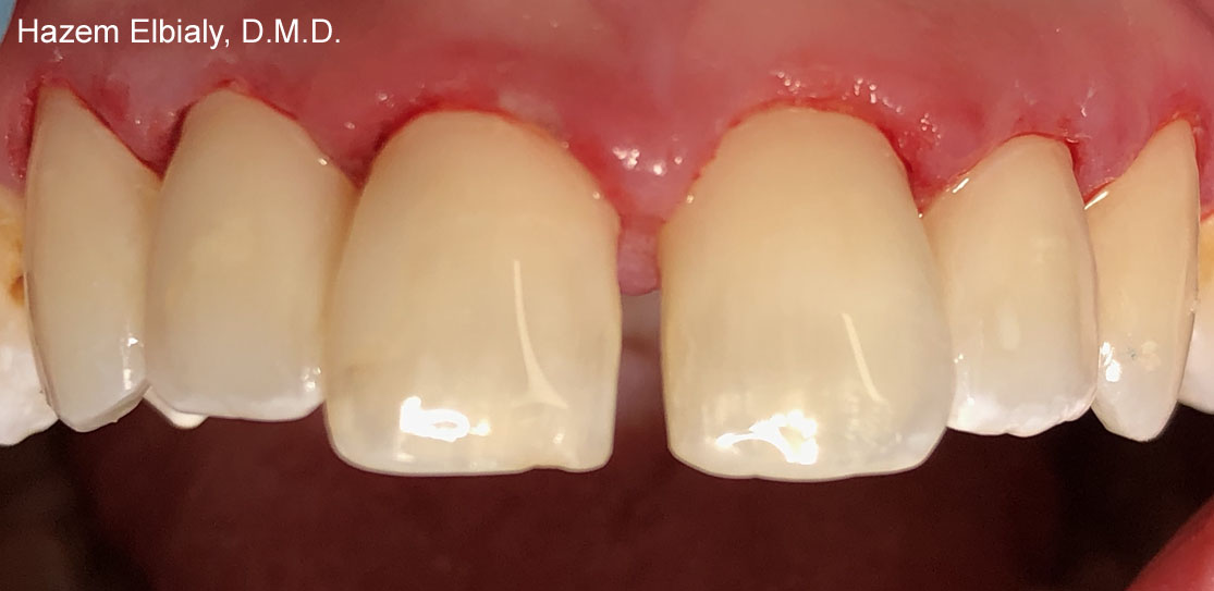 Close up of restored teeth after tooth colored fillings