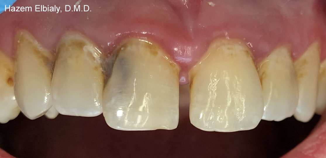 Close up of damaged teeth before tooth colored fillings