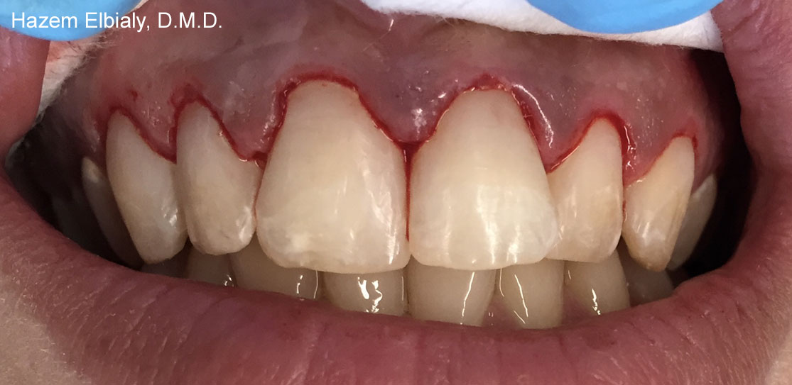 Close up of restored teeth after tooth colored fillings