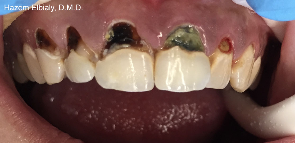 Close up of damaged teeth before tooth colored fillings