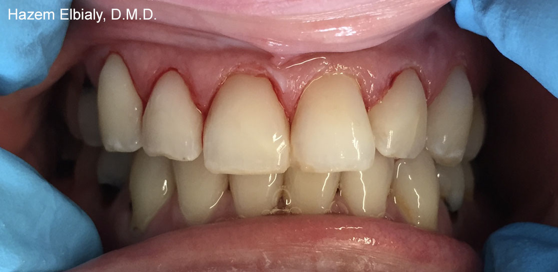 Close up of restored teeth after tooth colored fillings