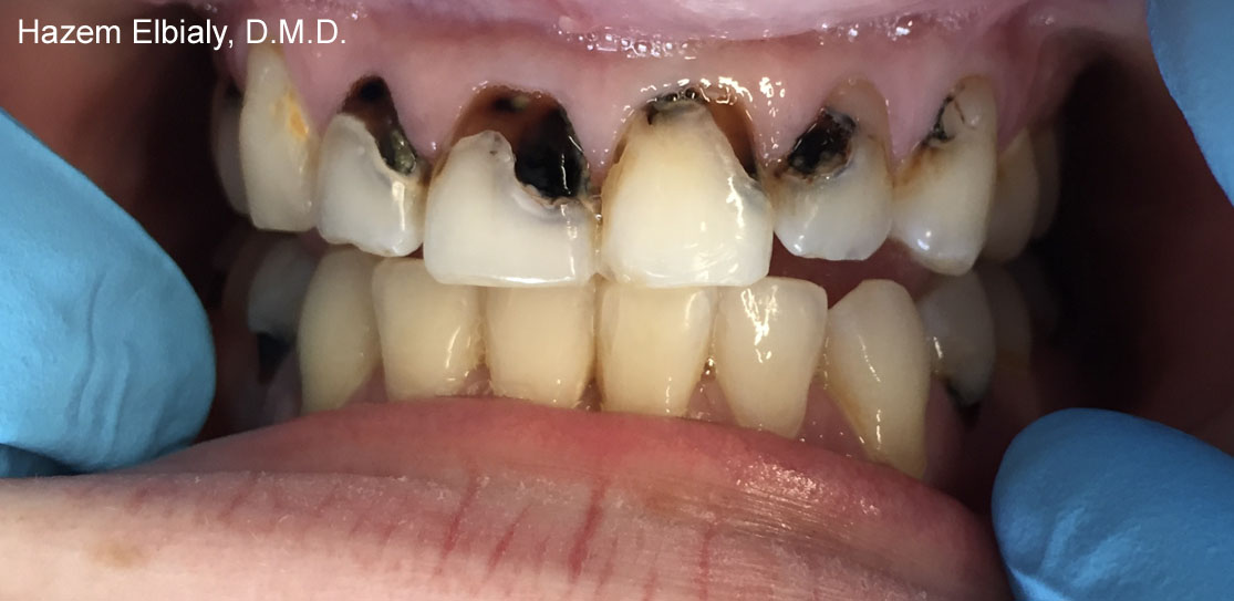 Close up of damaged teeth before tooth colored fillings