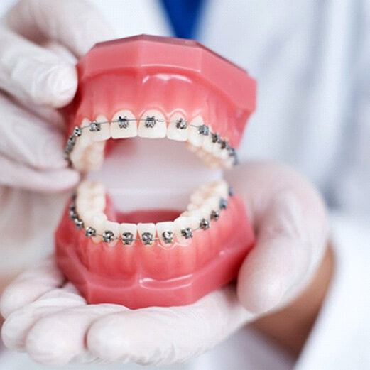 model of teeth with braces