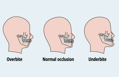 illustration of overbite, normal occlusion, and underbite