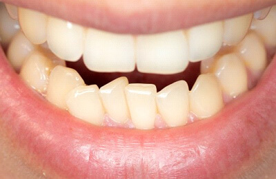 crowded teeth