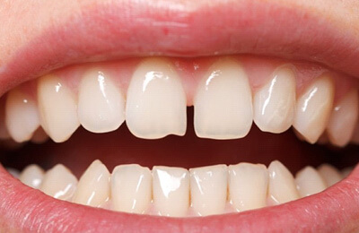 teeth with gao