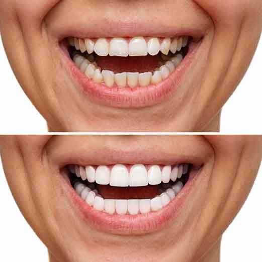 Woman showing teeth before and after veneers 