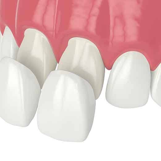 Digital graphic of veneers 